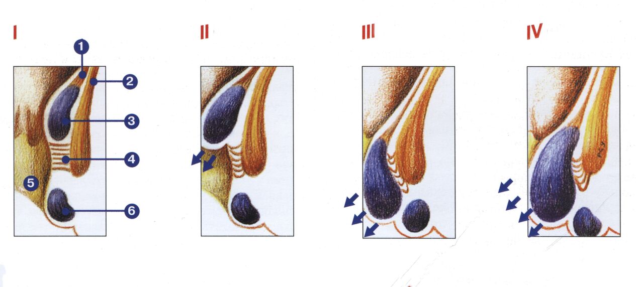 Etapas do desenvolvemento das hemorróidas