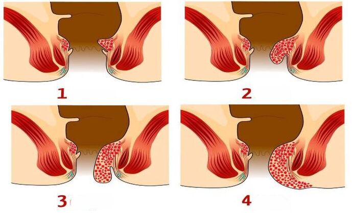 como se ven as hemorróidas en diferentes etapas